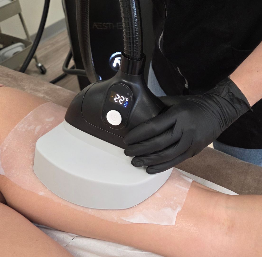 cryolipolyse carnaux
